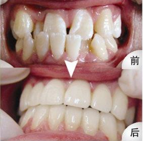 牙齿矫正多久可以看到效果