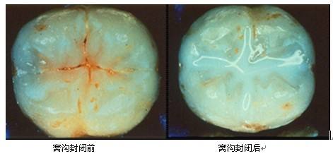 如何保障儿童窝沟封闭的效果