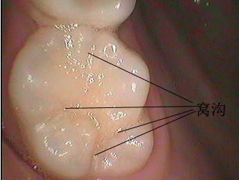 窝沟封闭技术是什么