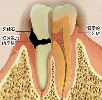 牙龈出血向你提示了什么