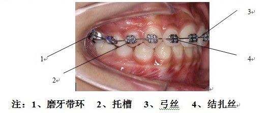 矫治器的护理要注意什么